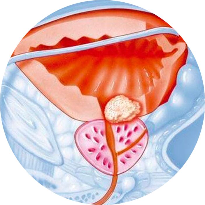 Adenoma of the prostate